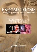 Endometriosis: Tratamiento Actual Y Futuras Tendencias